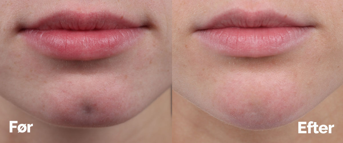 Hagekorrektion med filler